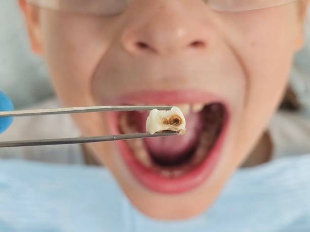Best Dentist for Severe Toothache  in Corcoran, CA