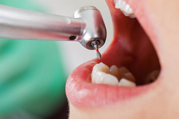 Best Dentist for Tooth Abscess  in Corcoran, CA